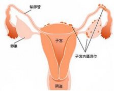微創(chuàng)聯合用藥兩期療 微創(chuàng)治療子宮內膜異位癥
