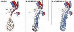 精索靜脈曲張有哪幾項檢查?要多少錢?