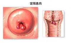 宮頸息肉手術(shù)治療怎么樣