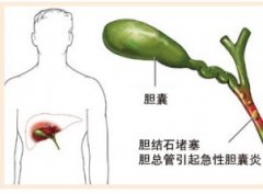 結石性膽囊炎是怎么回事?