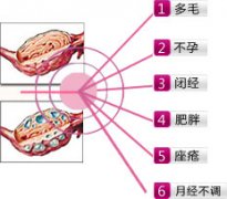 什么是多囊卵巢綜合癥？該如何治療？