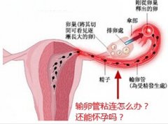 輸卵管粘連會造成什么危害，怎么預(yù)防呢